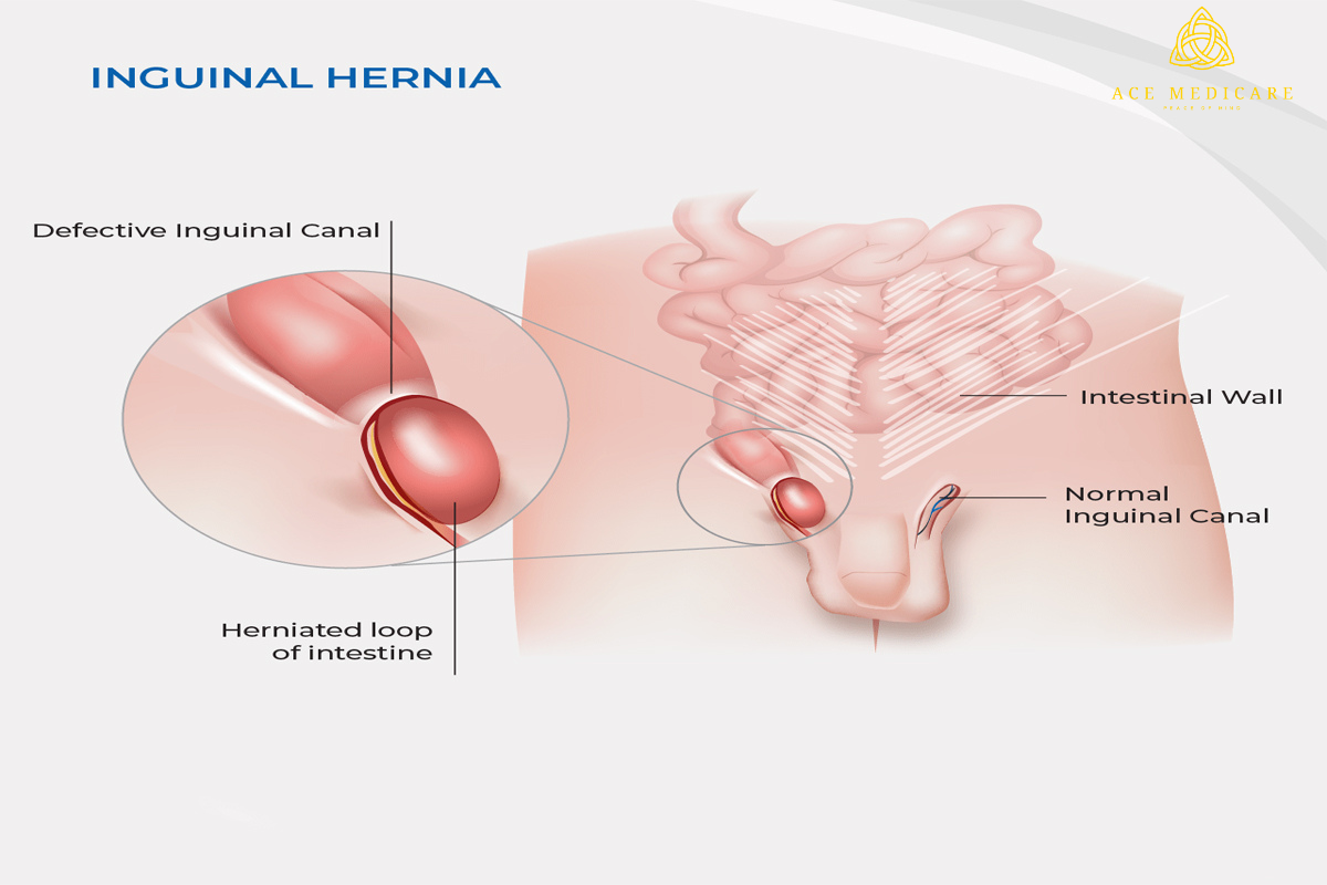 Hernia in Women: Unique Challenges and Treatment Options